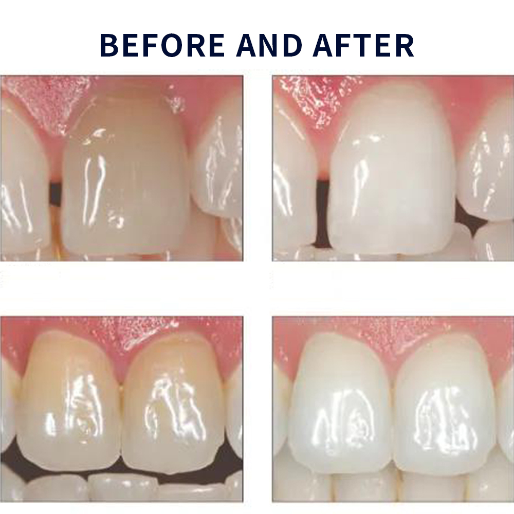 Opalescence Whitening 20% PF 2 - Teeth Whitening Gels Used By Dentists recensione e prezzo