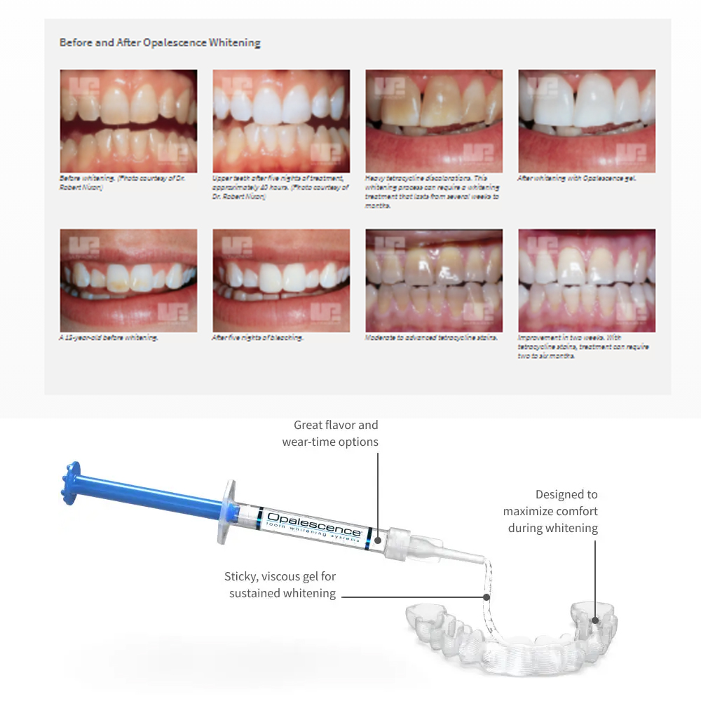 Opalescence Whitening 20% PF 2 - Teeth Whitening Gels Used By Dentists recensione e prezzo