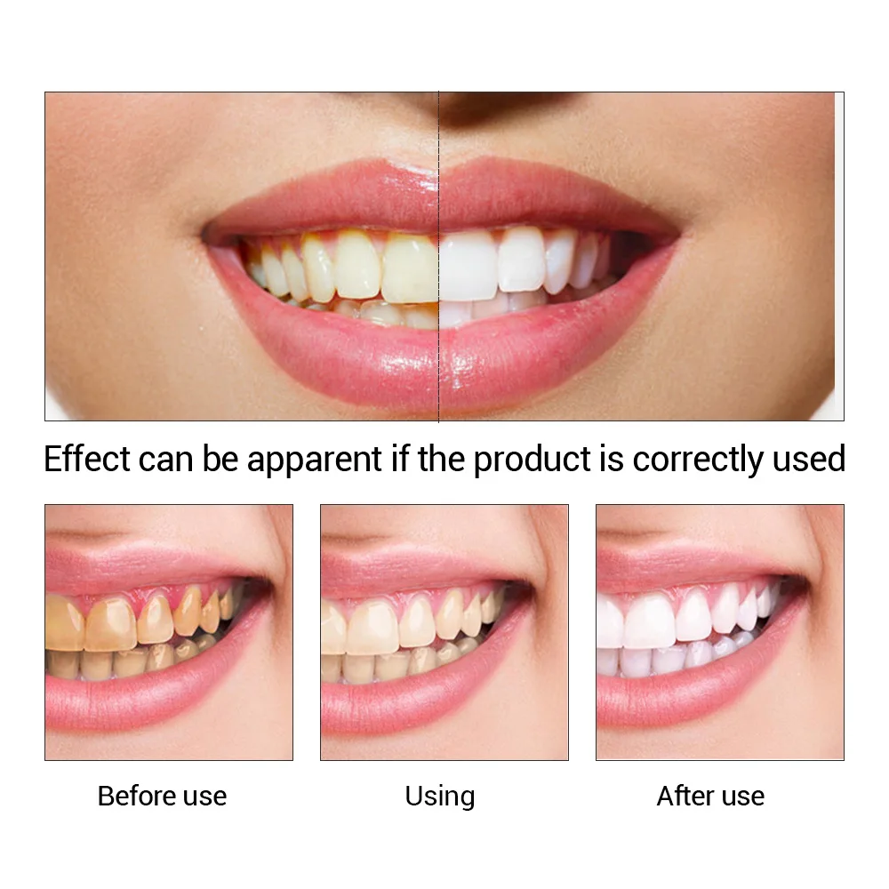 FTEENPLY Sbiancamento Dei Dent - Teeth Whitening Price recensione e prezzo