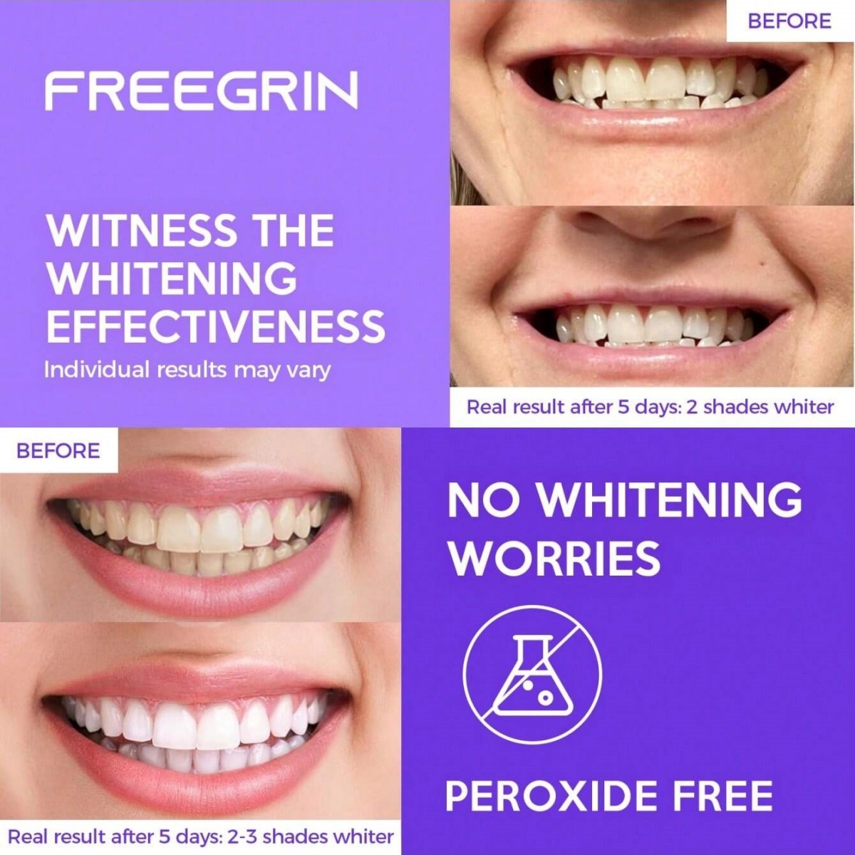 Adesivi sbiancanti per denti d - Teeth Whitening Gels Used By Dentists recensione e prezzo